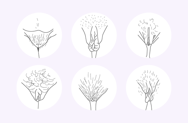 Hidradenitis suppurativa en plagsom hudsykdom Seks vulvaer