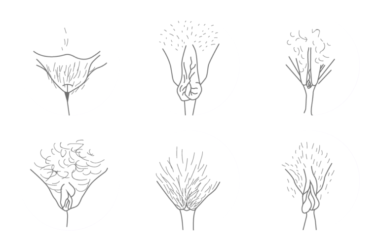 Seks vulvaer pasient