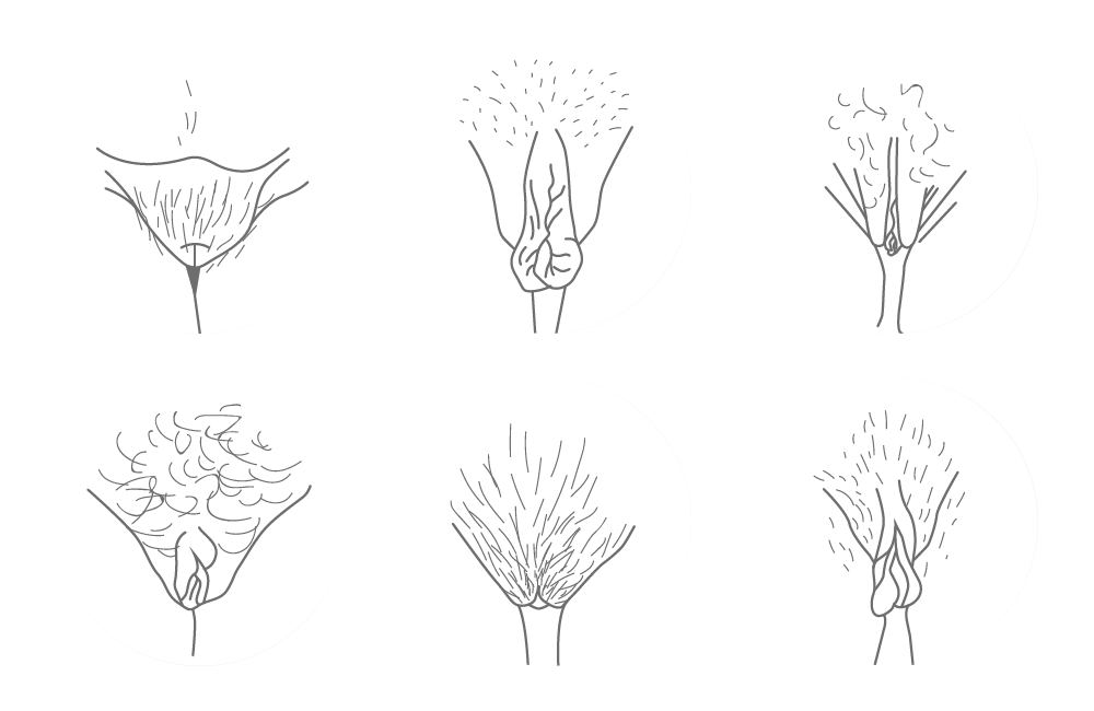 Seks vulvaer pasient