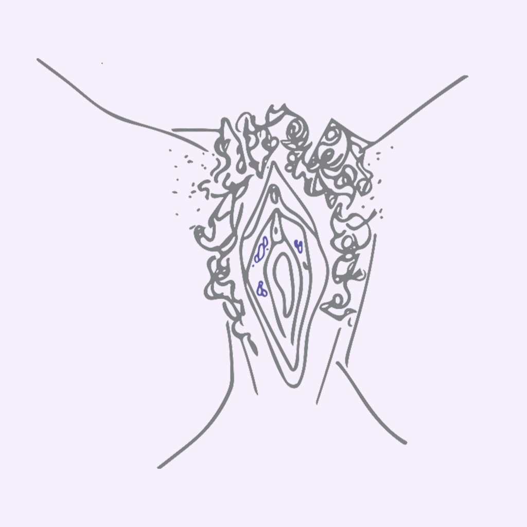 Herpes i vulva sykdommer