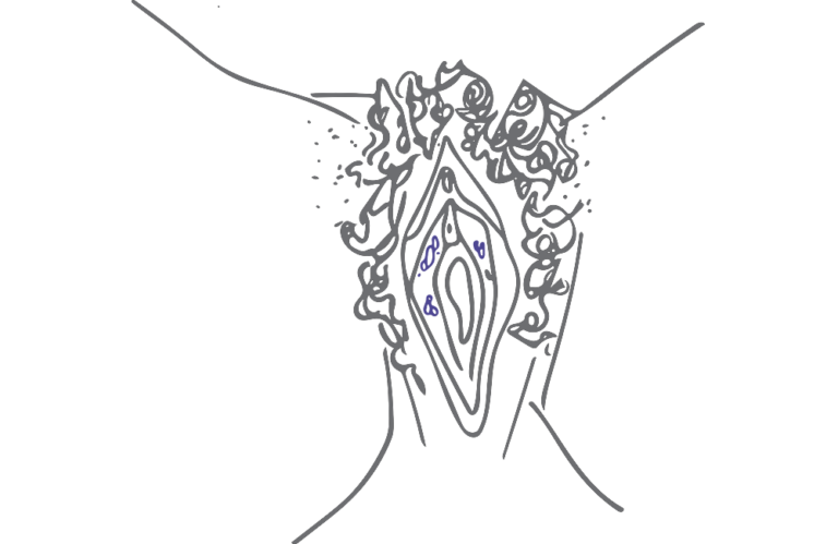 Illustrasjon vulva med herpes