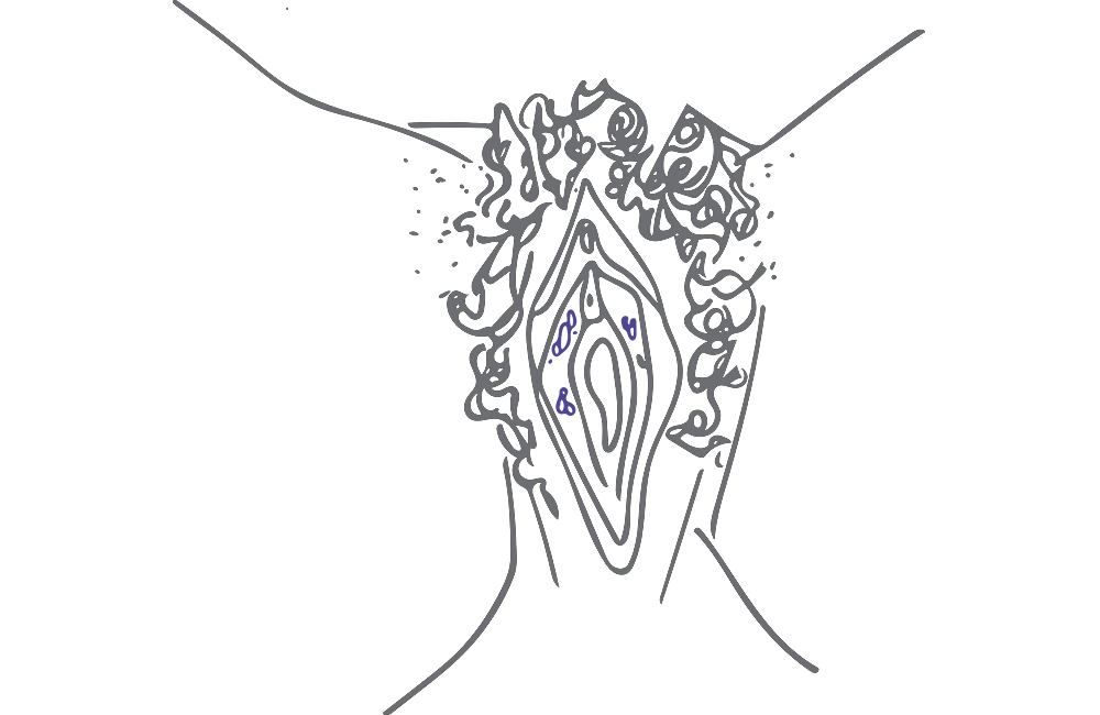 Illustrasjon vulva med herpes