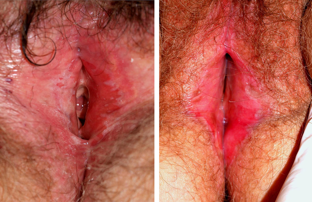 Sykdomseksempel Lichen Planus