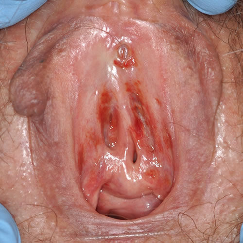 Plasmacelle vulvovaginitt