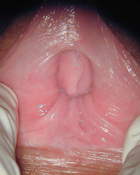 Sykdomseksempel vaginisme