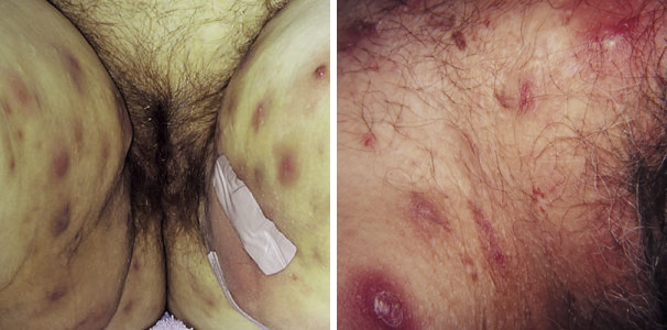 hidrandenitis sykdommer og tilstander