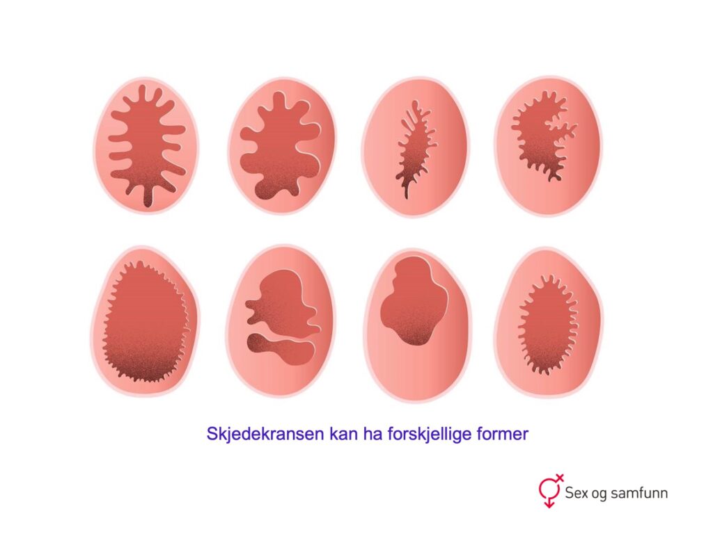 Skjedekransen kan ha forskjellige former