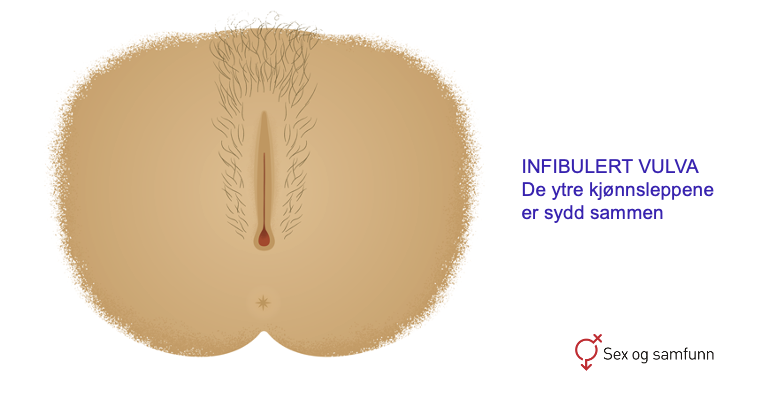 Infibulert Vulva